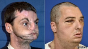 140731113108_transplante_cara_304x171_reuters