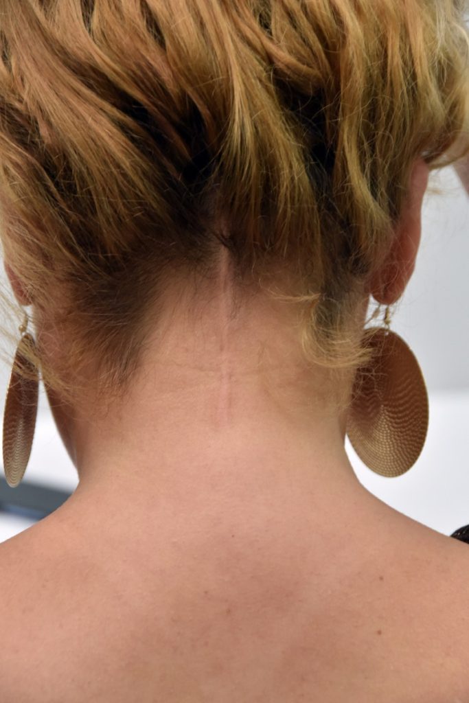 La cicatriz de Yeimy en la parte inferior de su cabeza.LEONEL ALMONTE